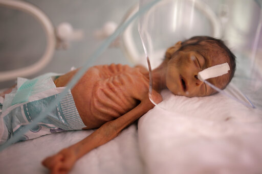 Un: Yemen Conflict Escalates As Country Speeds Toward Famine
