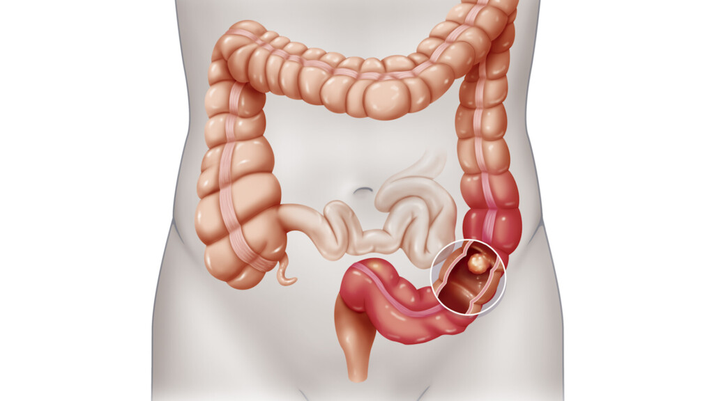 A Colonoscopy Study Has Some Wondering If They Should Have The Procedure. What You Should Know