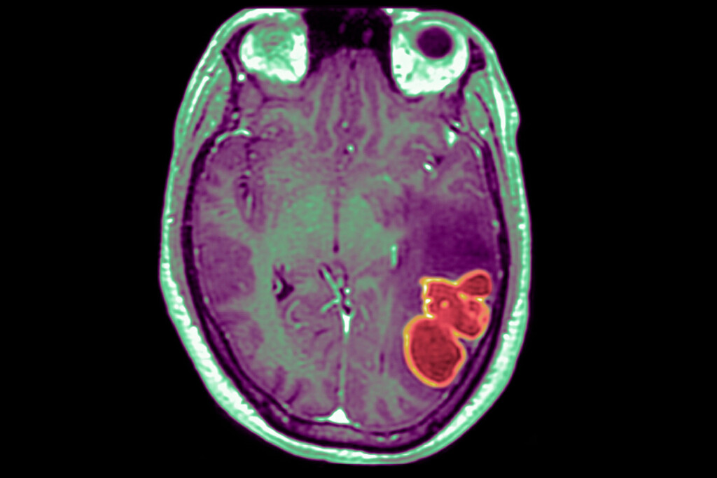 Doctors Watching For More Cases After Mysterious Cluster Of Brain Infections Strikes Kids In Southern Nevada