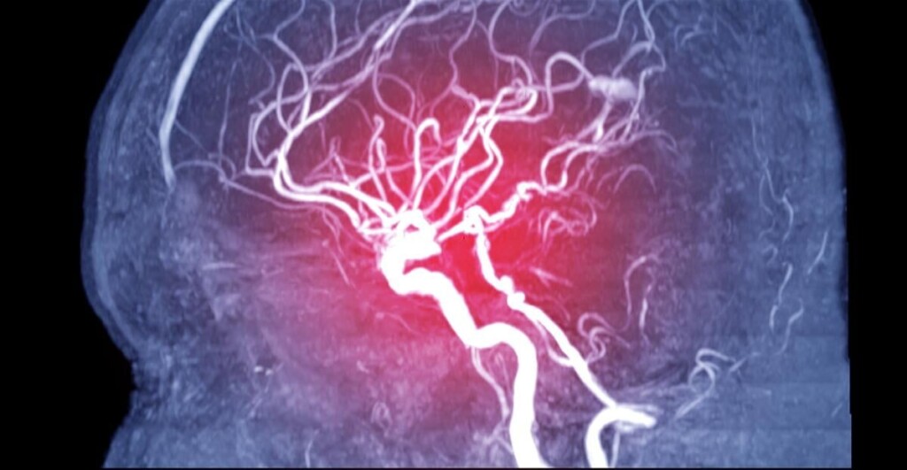 El Tratamiento Con Estimulación Cerebral Profunda Podría Hacer Que Los Brazos Y Las Manos Recuperen La Movilidad
