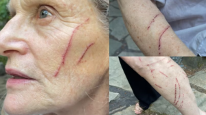 ‘it Was Monstrous’: Woman Attacked By Raccoon While Letting Dogs Out For Walk