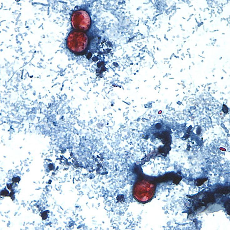 Massive Cyclosporiasis Outbreak Linked To Four More States