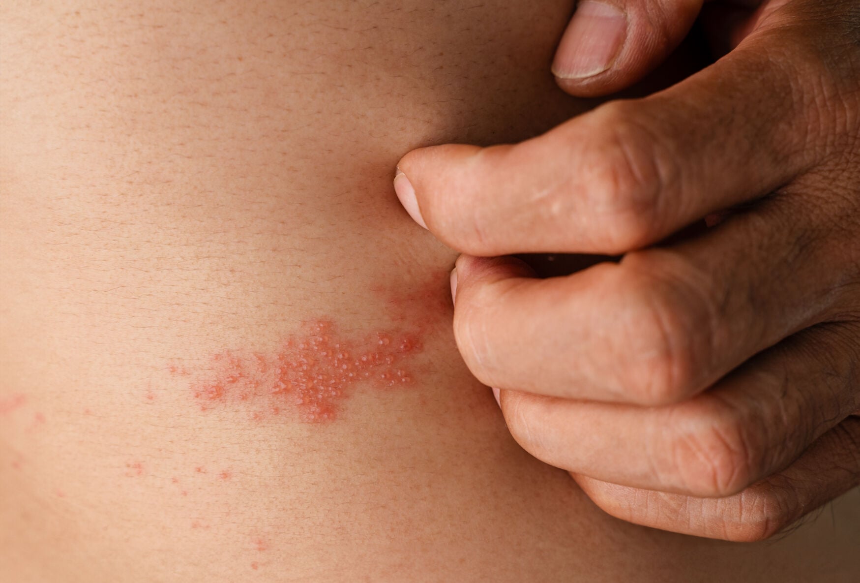 <p>A shingles rash often occurs on the back, chest or abdomen.</p>