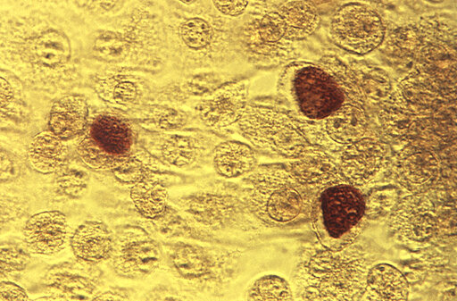 Covid Testing Blitz Undermined Screening, Fight Against Stds