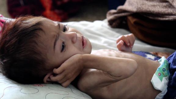 She’s Nearly 3 But As Small As An Infant. This Is The Face Of Afghanistan’s Hunger Crisis